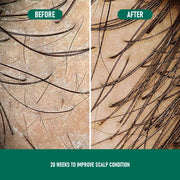 Anti-Hair Loss Mousse CH004 Minoxidil Anti-Hair Loss Mousse