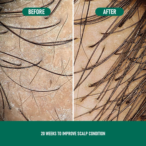 Anti-Hair Loss Mousse CH004 Minoxidil Anti-Hair Loss Mousse