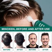 Anti-Hair Loss Mousse CH004 Minoxidil Anti-Hair Loss Mousse