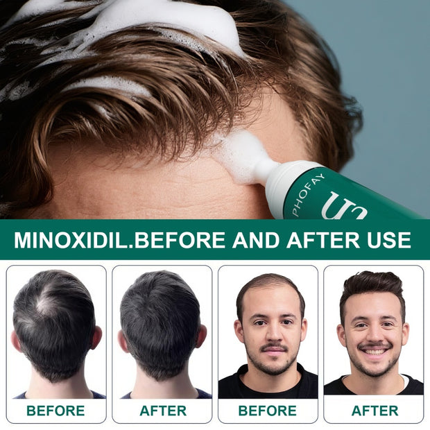 Anti-Hair Loss Mousse CH004 Minoxidil Anti-Hair Loss Mousse
